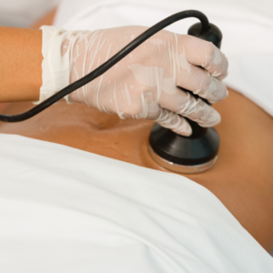 lipocavitation